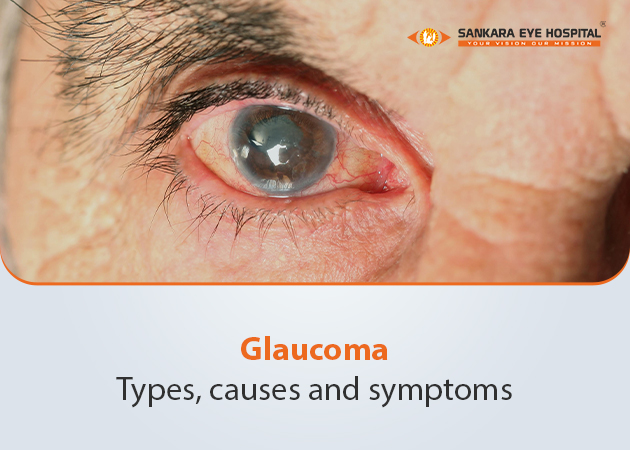 glaucoma eye treatment
